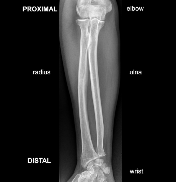 Forearm fractures